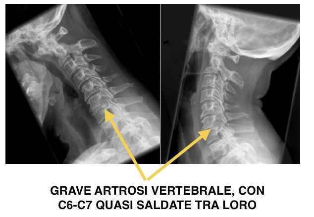 Sintomi neurologici dell'artrosi cervicale: tra parestesie e ansia