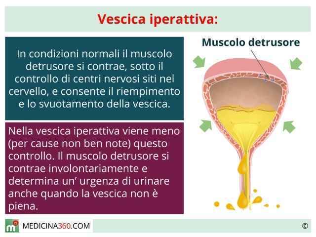 Vescica Neurologica: Sintomi, Cause e Possibili Cure
